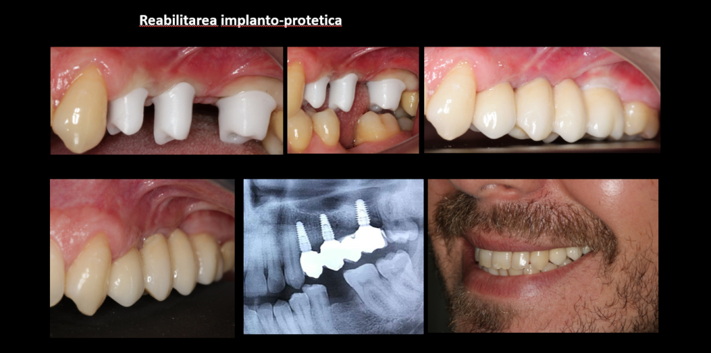 Reabilitare implanto-protetica inainte si dupa – cazul 1 reabilitare implanto-protetica inainte si dupa - cazul 1 Ridere Suceava